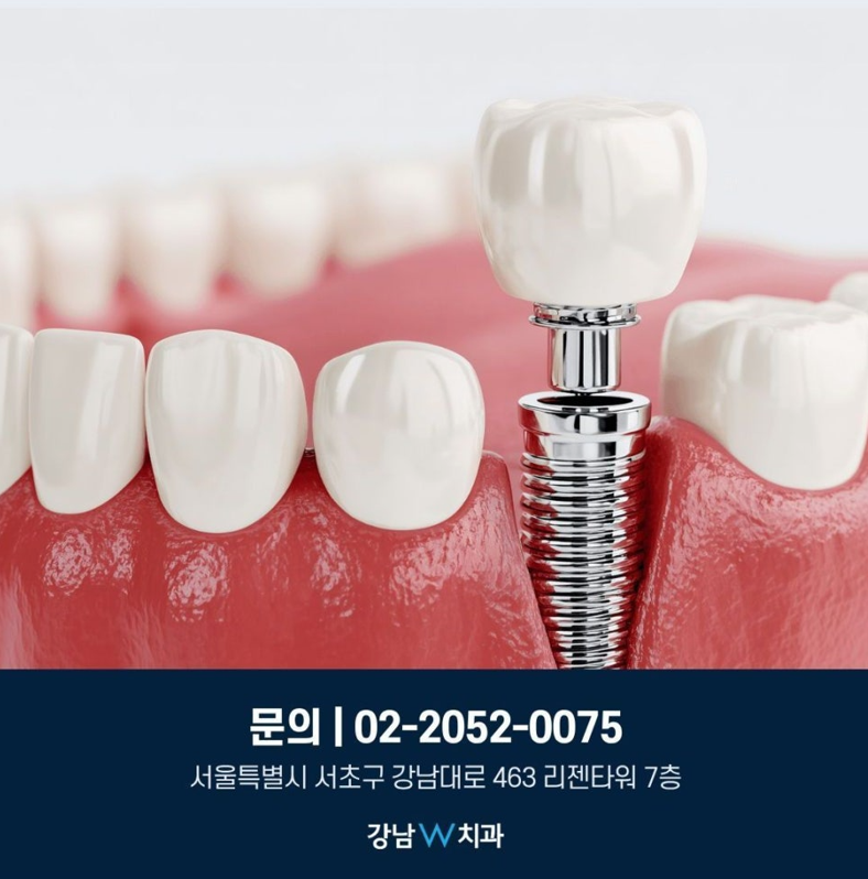 임플란트종류, 나에게 맞는 임플란트 추천 기준은 따로 있습니다 4 임플란트종류, 나에게 맞는 임플란트 추천 기준은 따로 있습니다 2